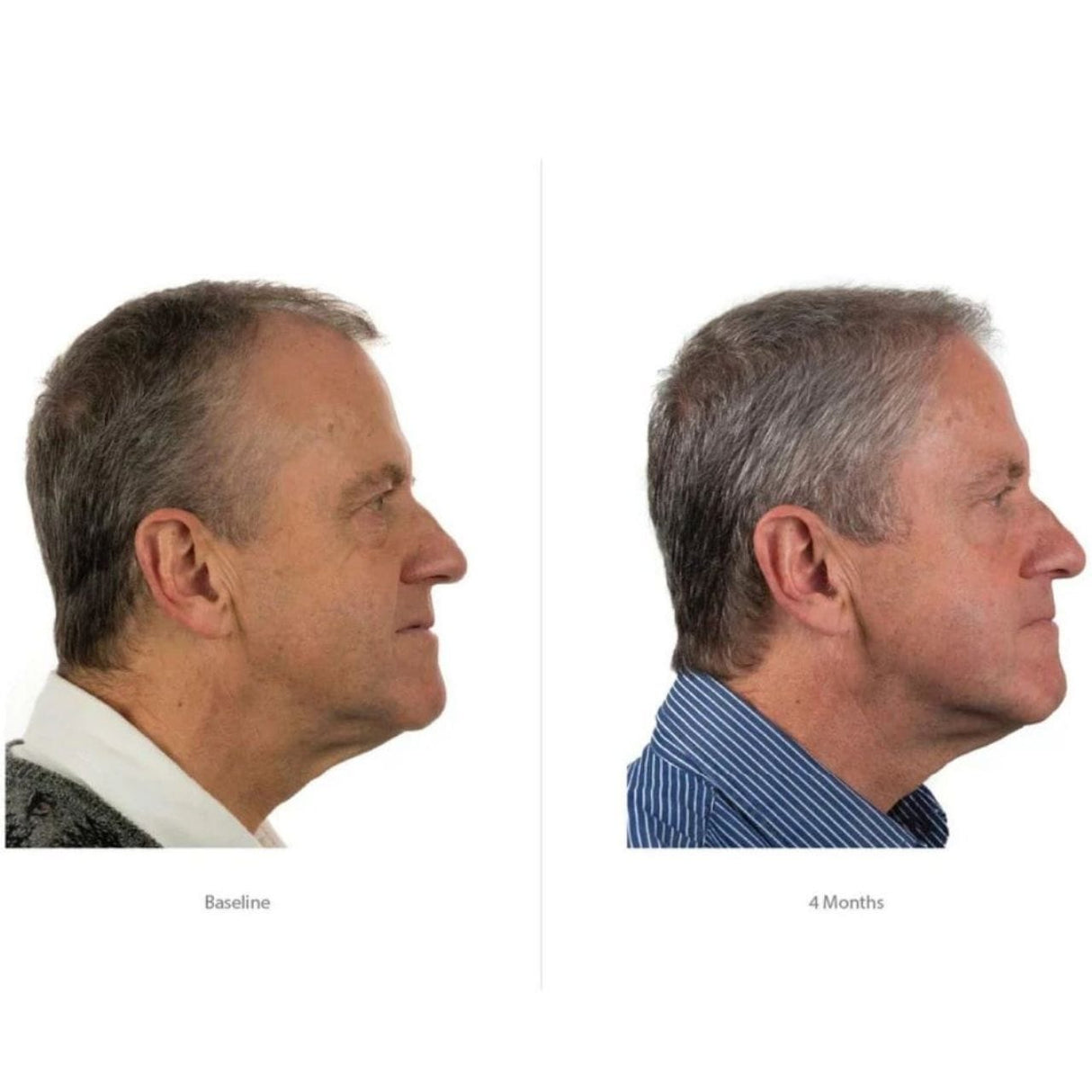 Foligain Triple Action Complete Formula For Thinning Hair For Men - 59 ml